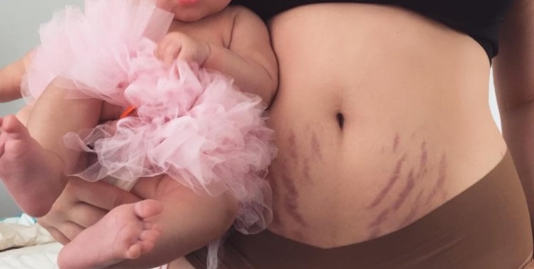 postpartum stretch marks