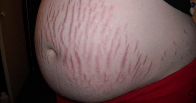 postpartum stretch marks